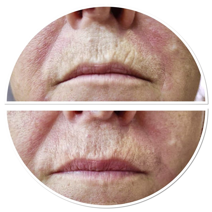 BT Rejuvenation before and after result 69