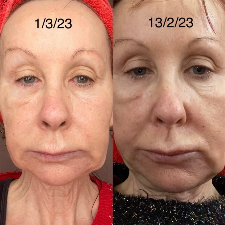 BT Rejuvenation before and after result 7