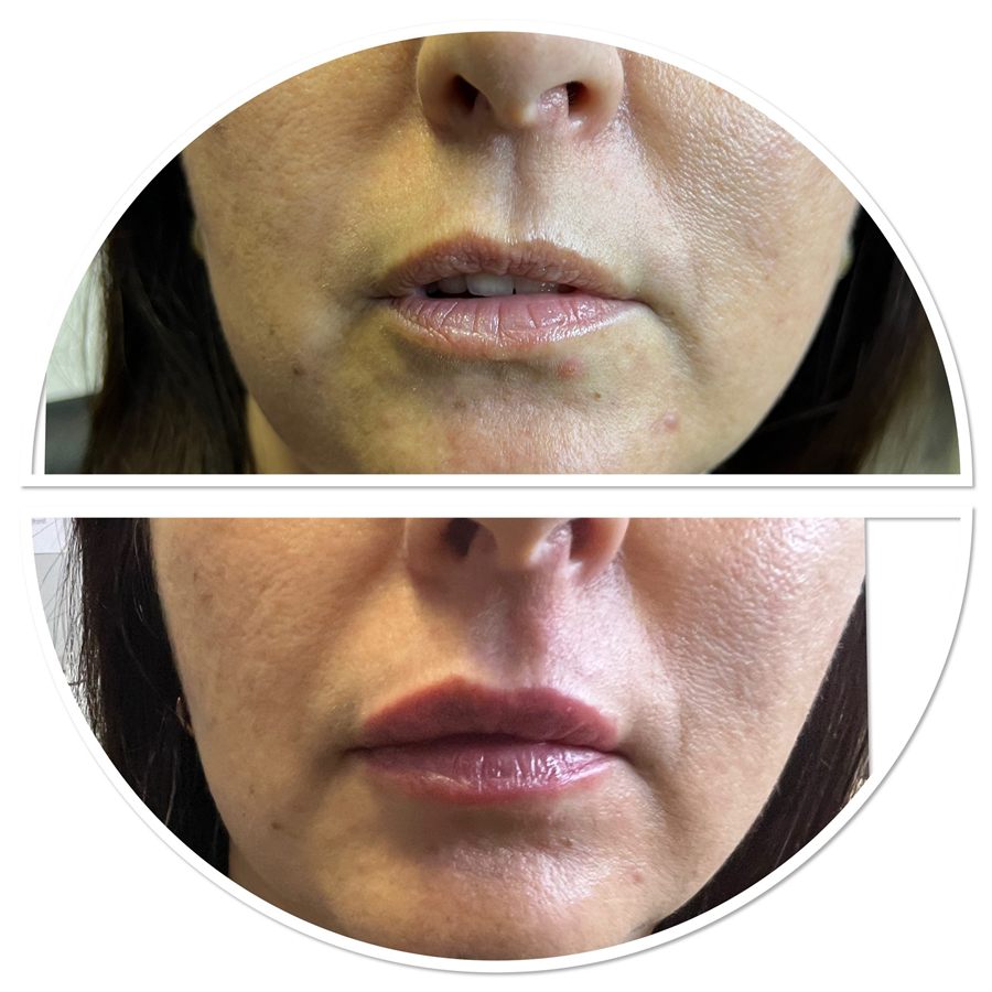 BT Rejuvenation before and after result 70