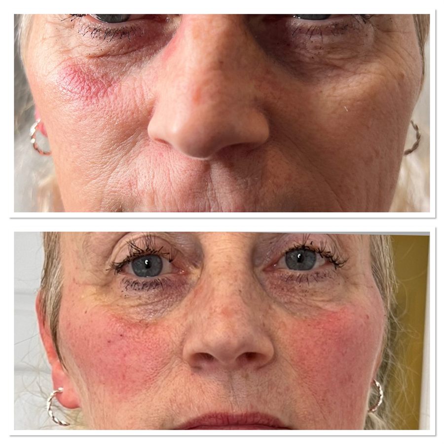 BT Rejuvenation before and after result 71