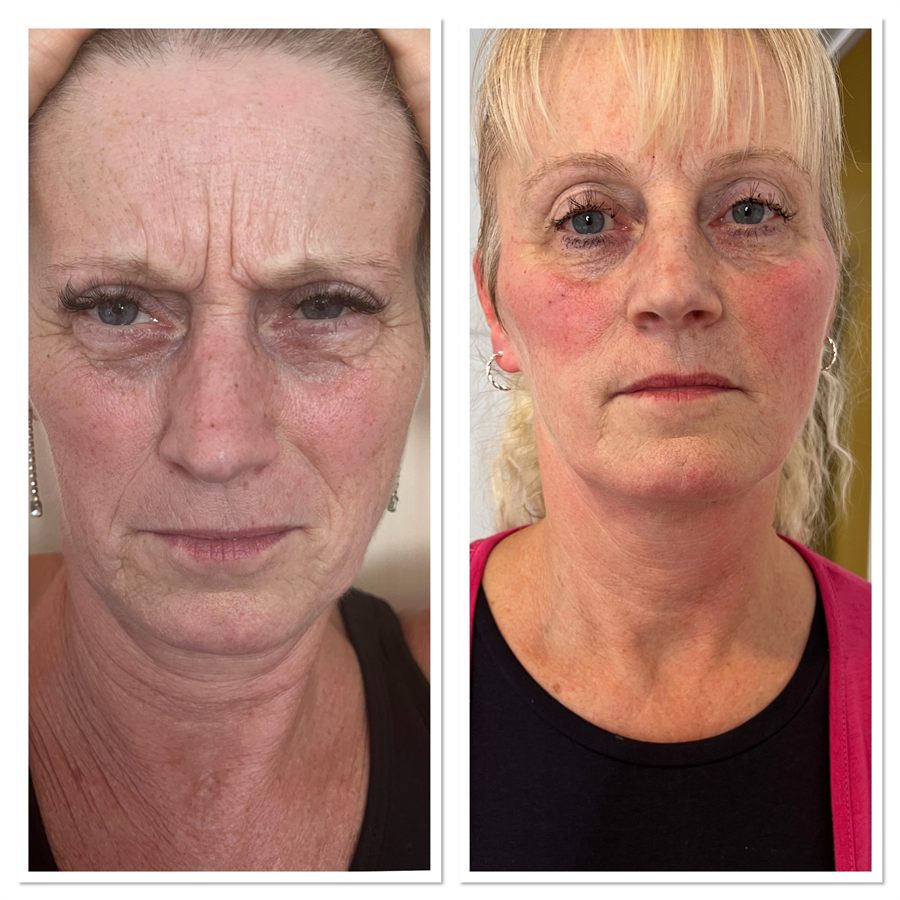 BT Rejuvenation before and after result 72