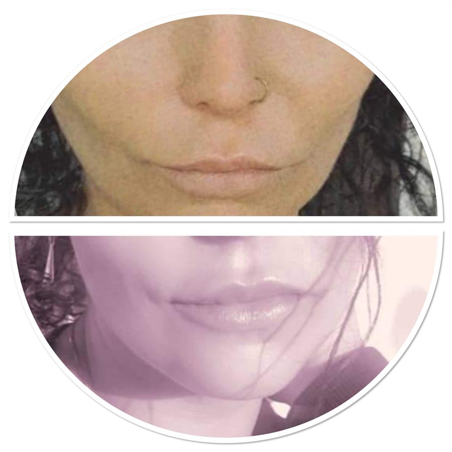 BT Rejuvenation before and after result 74