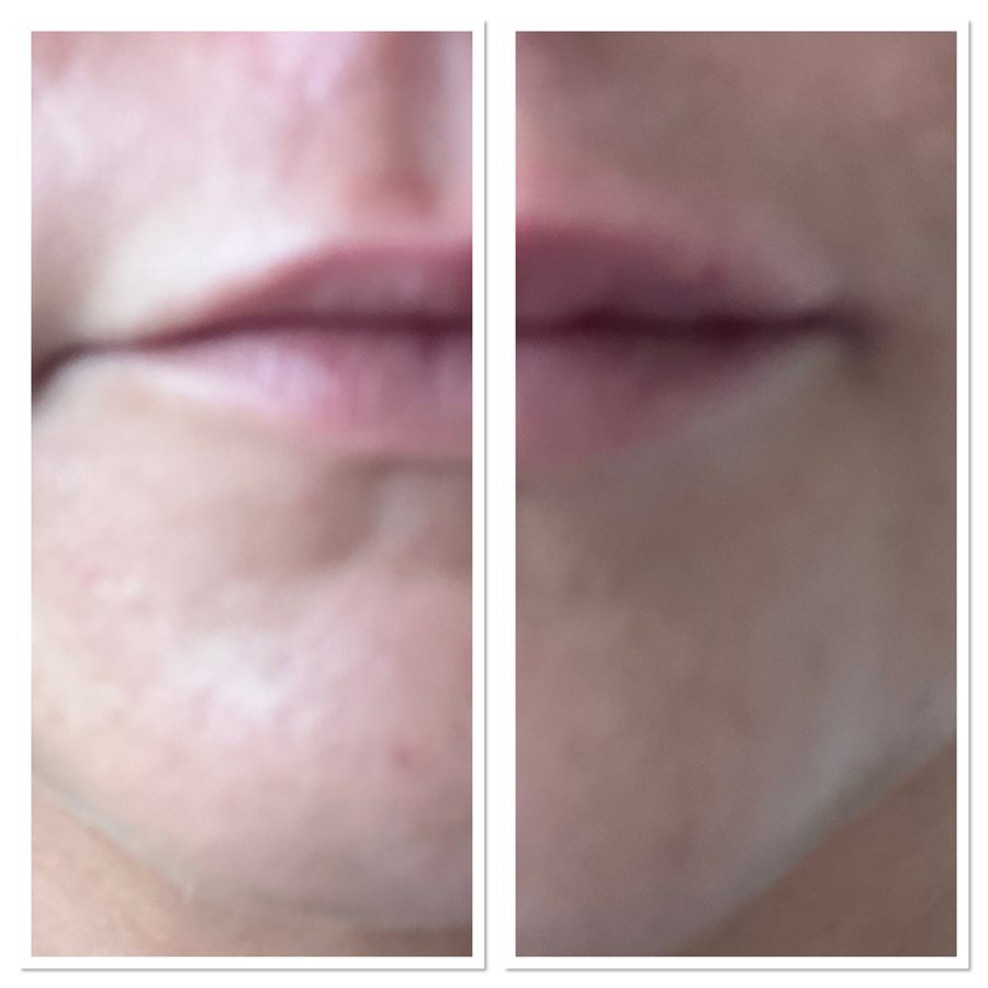 BT Rejuvenation before and after result 75