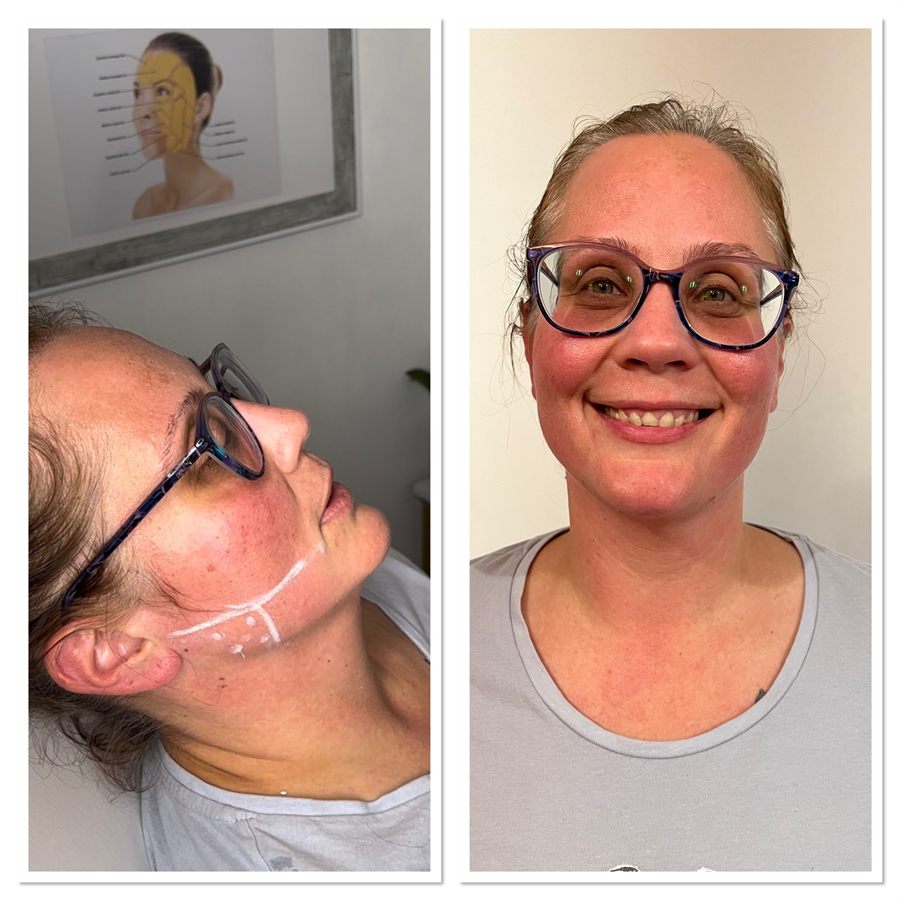 BT Rejuvenation before and after result 77