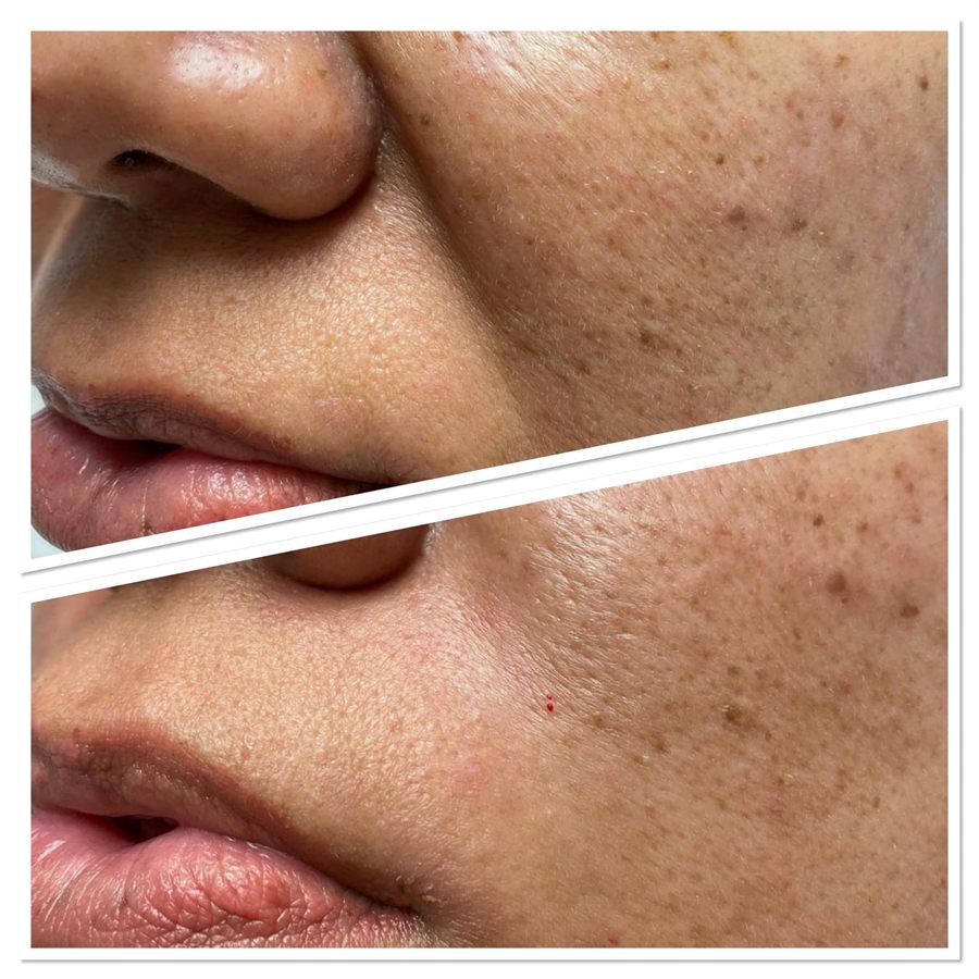 BT Rejuvenation before and after result 78