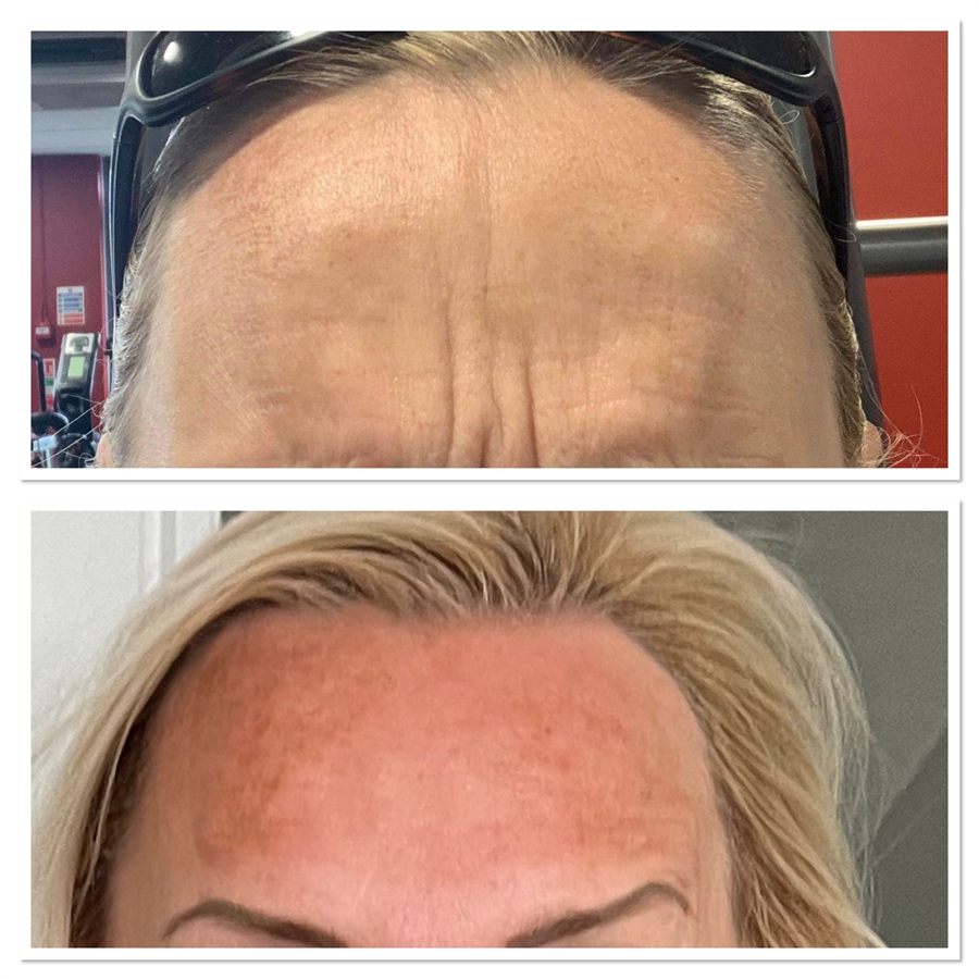 BT Rejuvenation before and after result 79