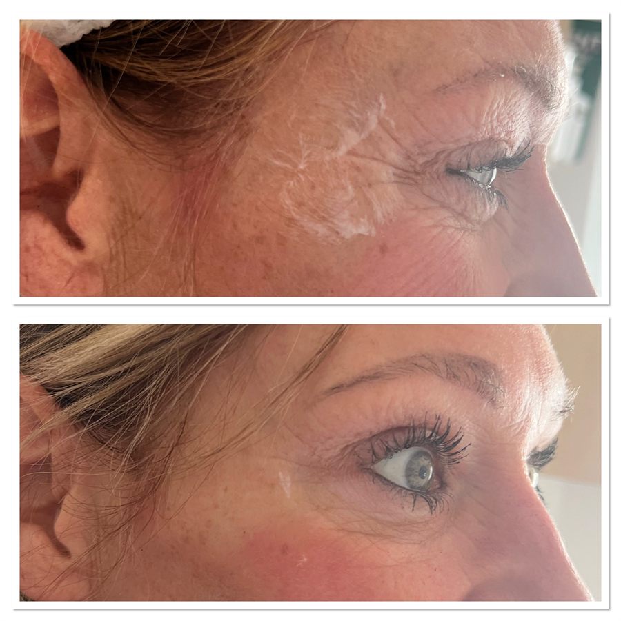 BT Rejuvenation before and after result 80