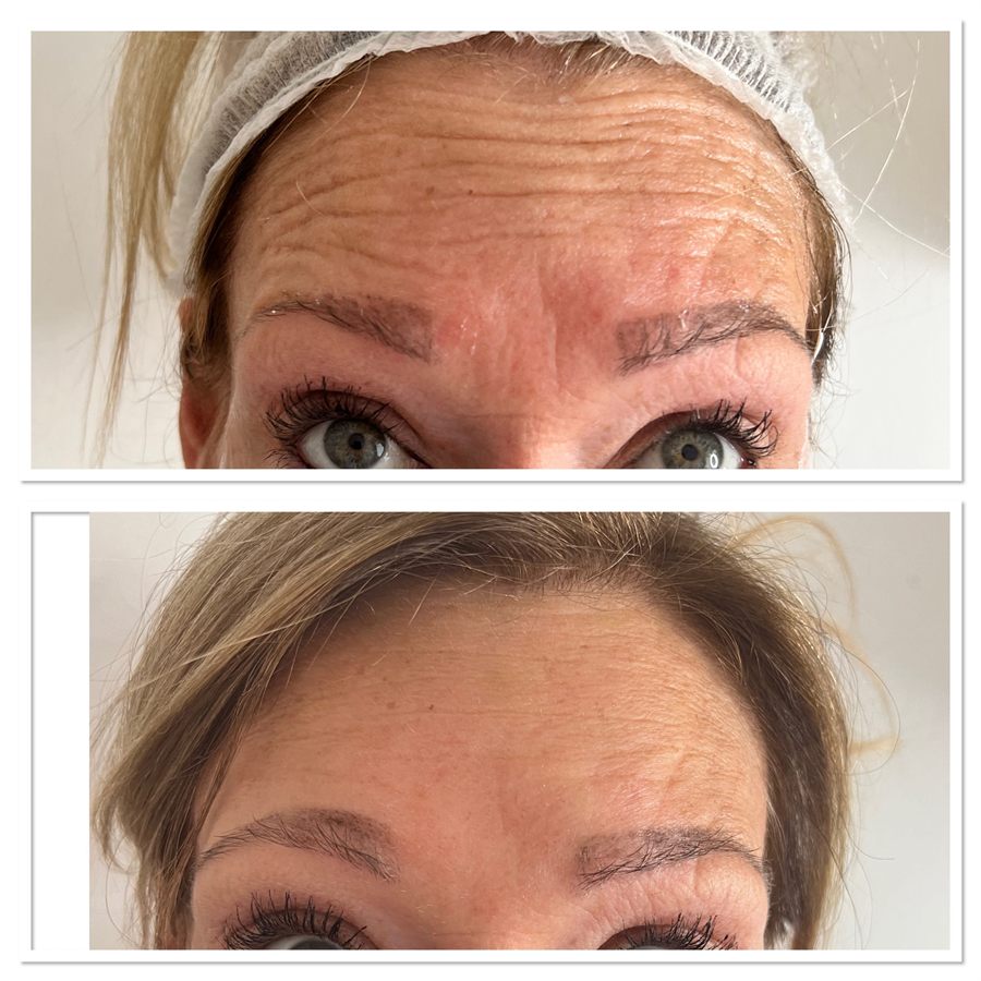 BT Rejuvenation before and after result 81