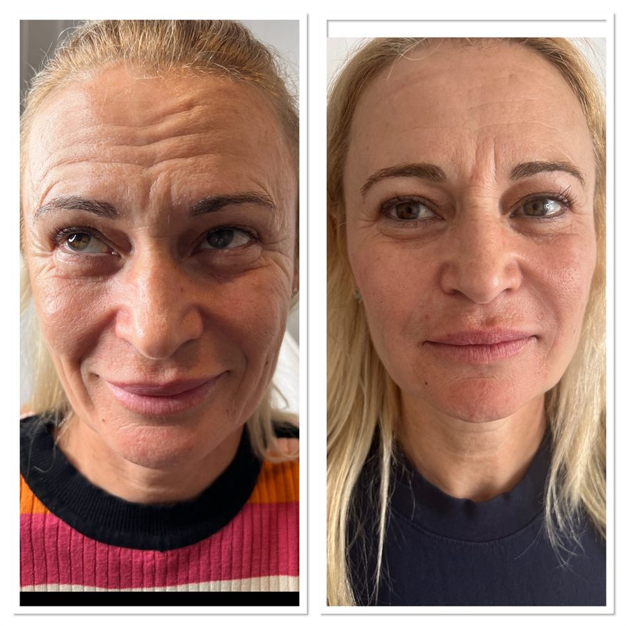 BT Rejuvenation before and after result 82