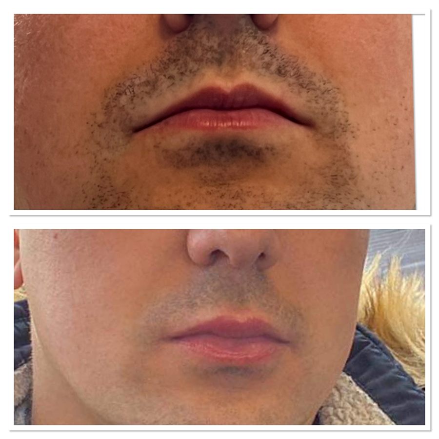 BT Rejuvenation before and after result 83