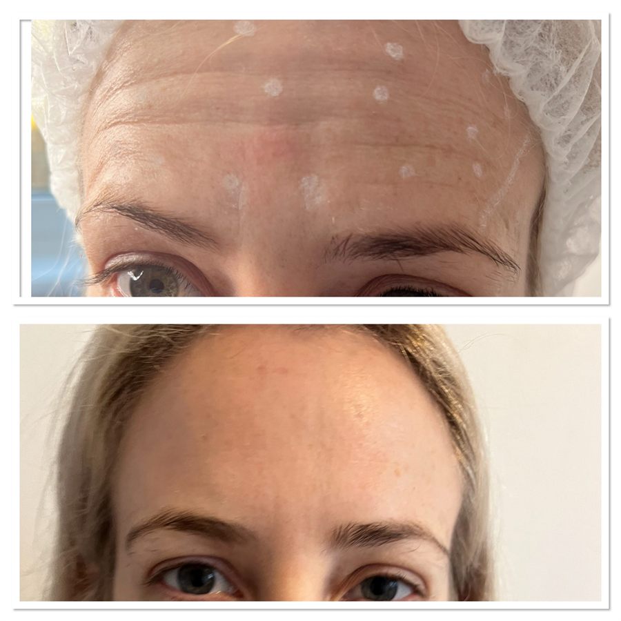 BT Rejuvenation before and after result 84