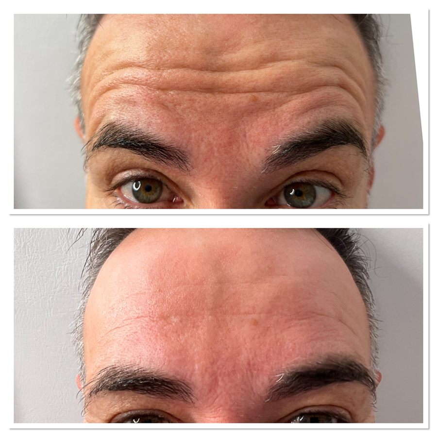 BT Rejuvenation before and after result 85