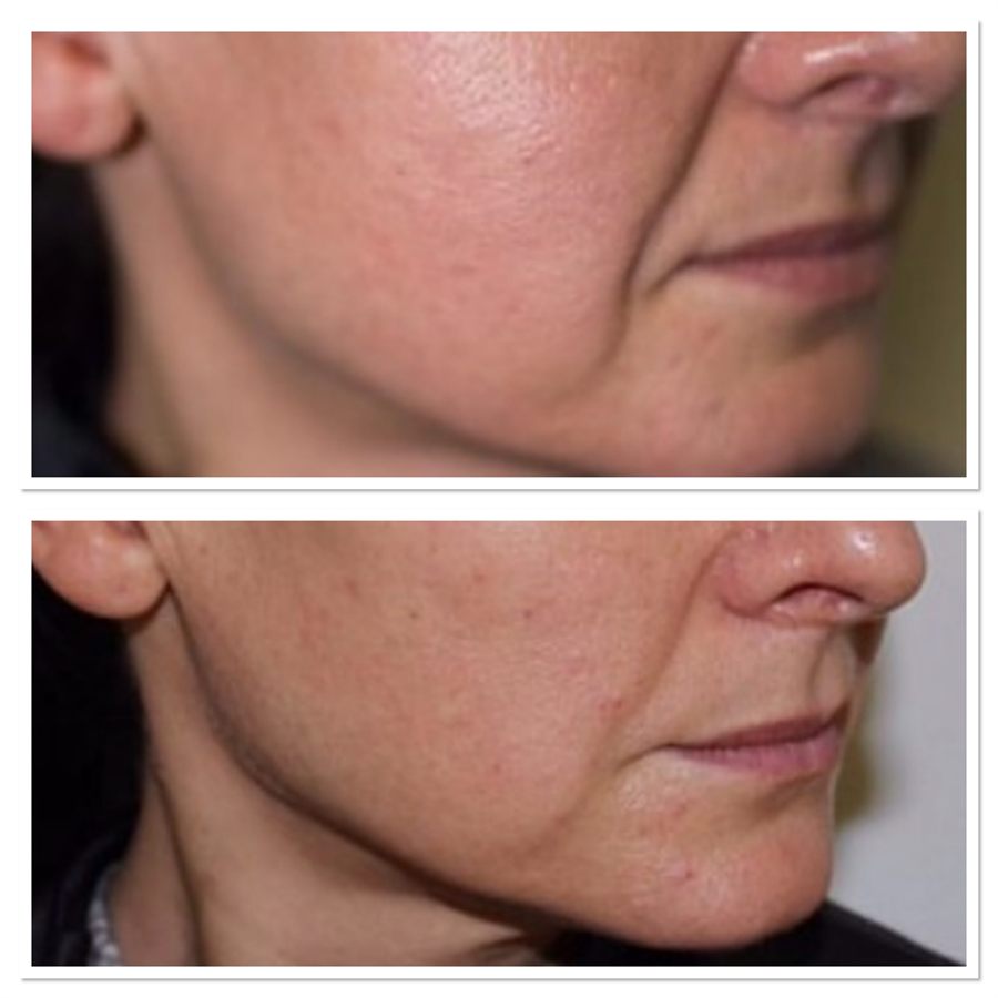 BT Rejuvenation before and after result 86