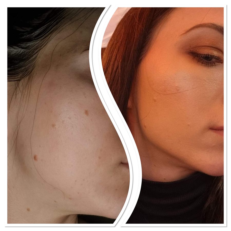 BT Rejuvenation before and after result 87