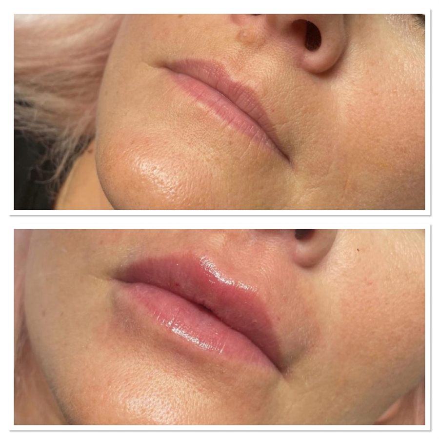 BT Rejuvenation before and after result 88