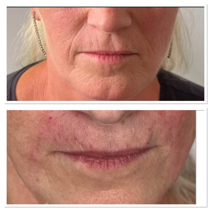 BT Rejuvenation before and after result 89