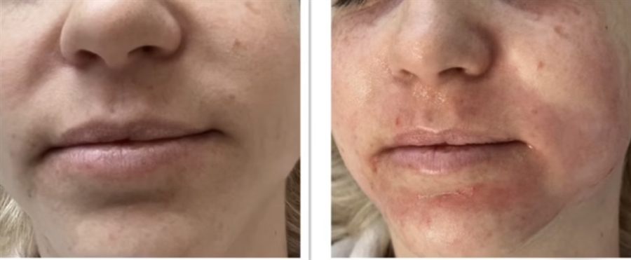 BT Rejuvenation before and after result 9